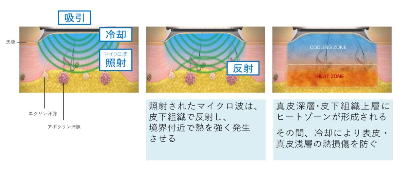 ミラドライ説明画像